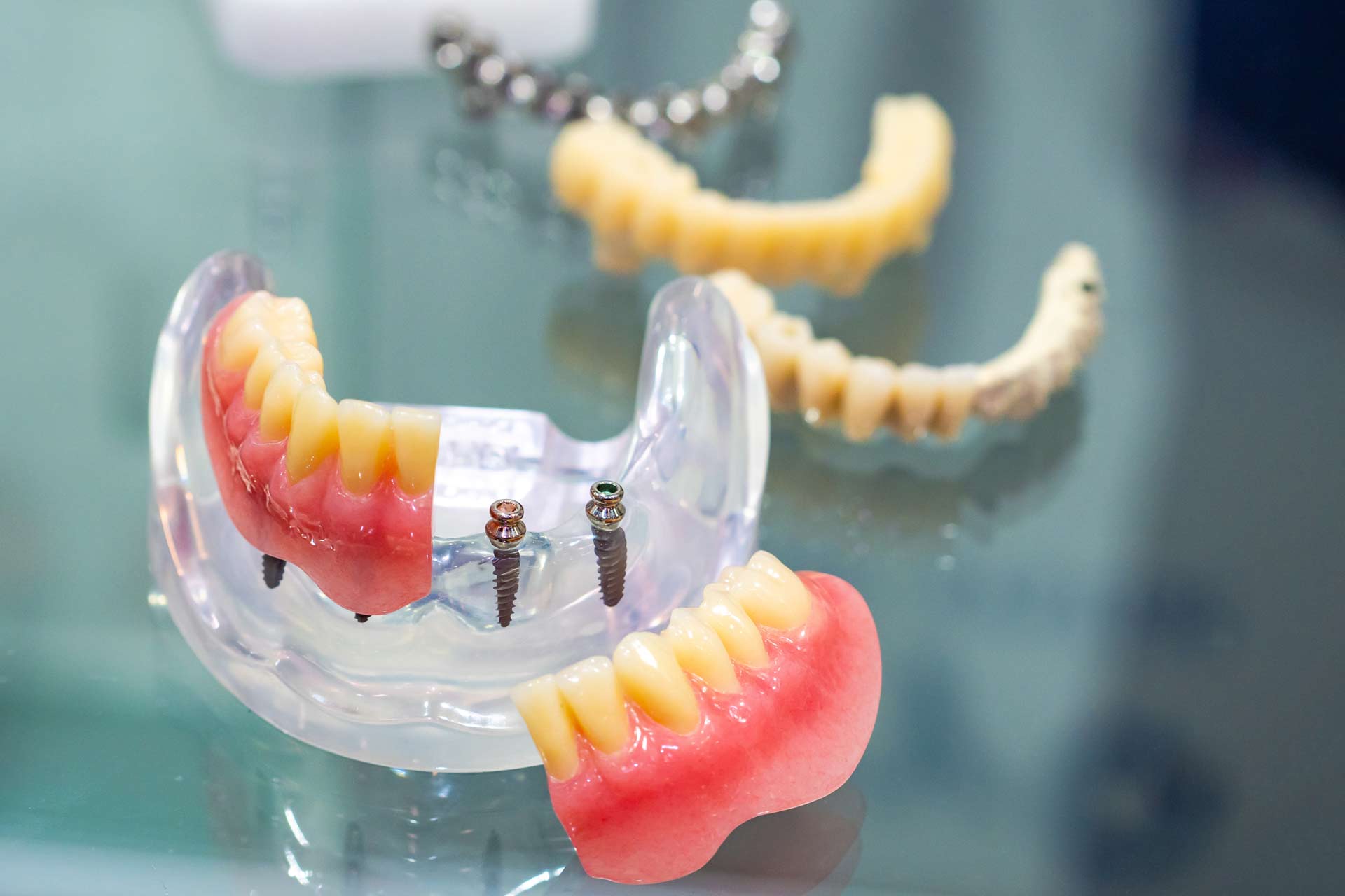 Dentures on Mini-Implants: The Ultimate in Denture Stabilization